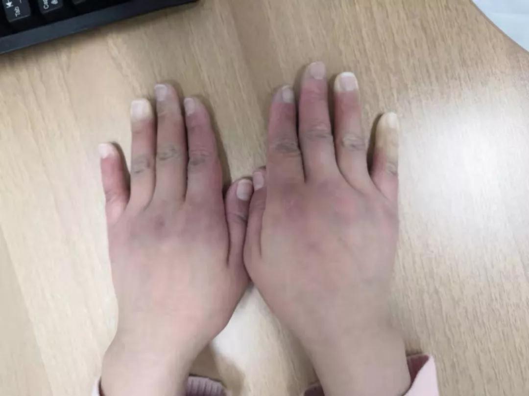 “手指、腳趾發(fā)白、發(fā)紫……”這些“小毛病”千萬別大意