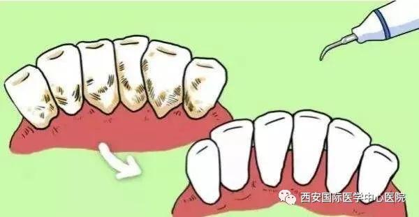 牙齒上的黃斑好難看，三招告訴你如何預(yù)防氟斑牙