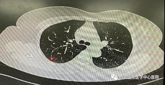 胸科醫(yī)院完成西北地區(qū)首例“Lung Pro全肺診療導航系統(tǒng)聯(lián)合單孔胸腔鏡下右肺上葉后段切除術”