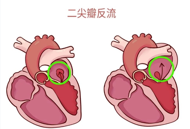 體檢報(bào)告里的心臟瓣膜返流，你讀懂了嗎？